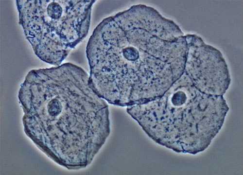Клетки мезотелия в гинекологии