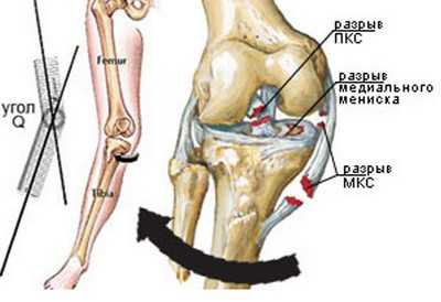 Как называется ушиб коленного сустава thumbnail