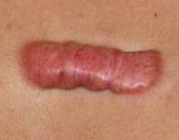 Келоидный рубец после ожога лечение thumbnail