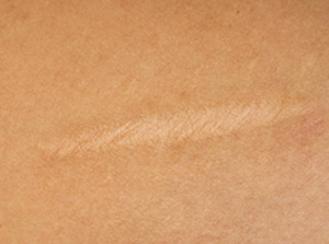 Лечение шрамов после химических ожогов thumbnail