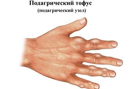 Хирургическое лечение подагры в россии thumbnail