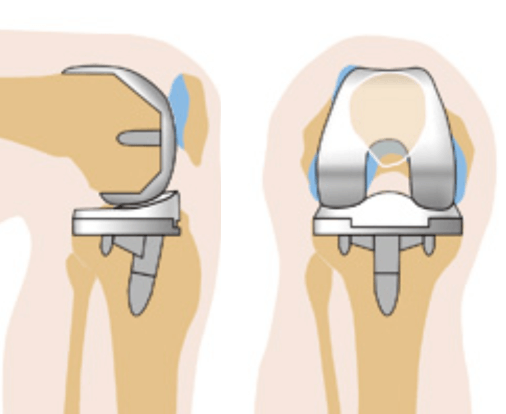 Замена коленного сустава